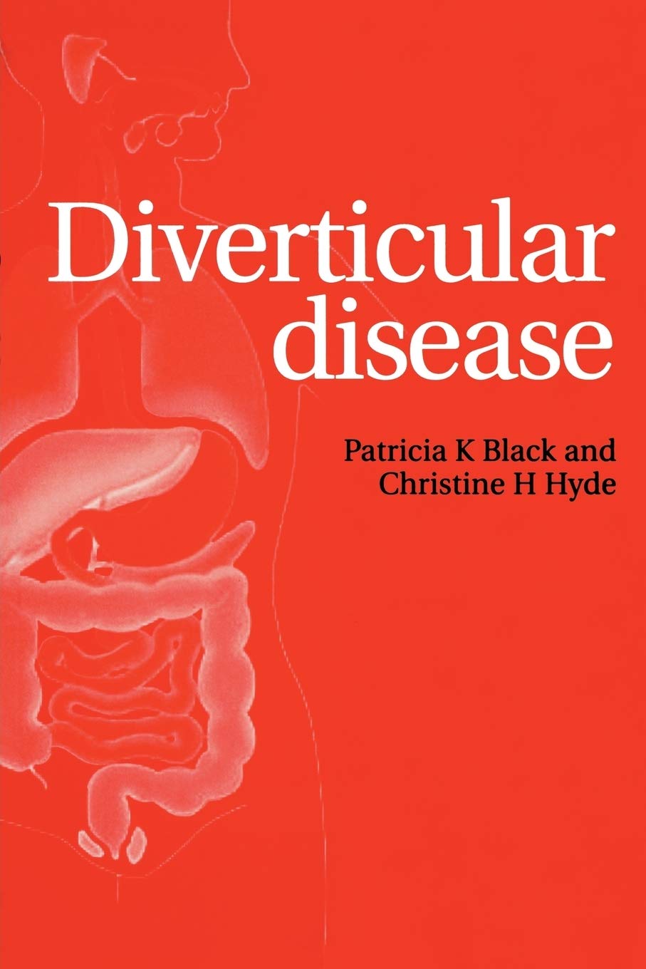 Diverticular Disease Main image