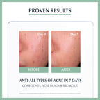 Eucerin ProACNE Solution SOS Serum 40ml, Anti Acne, Acne Prone Skin